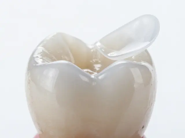 Fazety na zuby: Kdy je nejlepší na ně přejít a jak fungují?